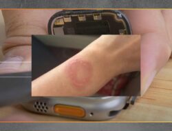 Apple Watch Overheat Picu Luka, Penanganan Lambat